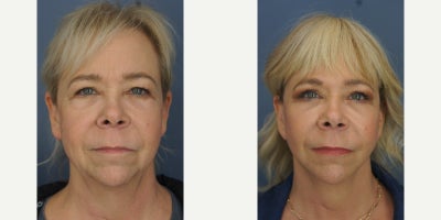 before and after image