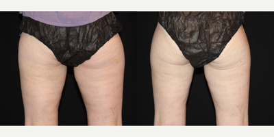 CoolSculpting before and after photo