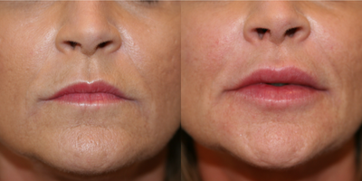 Dermal Fillers before and after photo