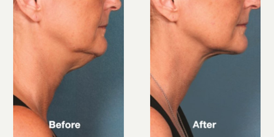 Kybella before and after photo