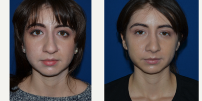 Rhinoplasty before and after photo