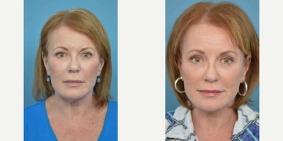 Rhinoplasty before and after photo