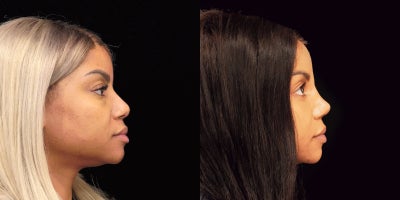 Rhinoplasty before and after photo
