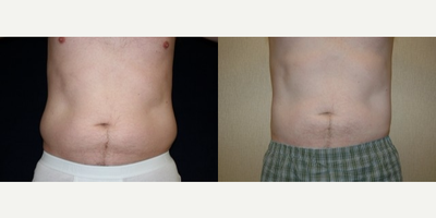 Smart Lipo before and after photo