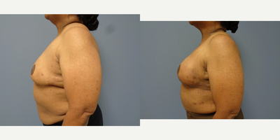 Breast Reconstruction before and after photo