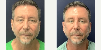 before and after image