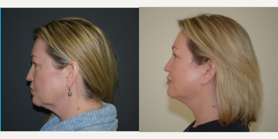 Facelift before and after photo