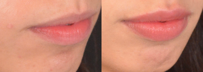 Lip Fillers before and after photo