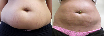 Smart Lipo before and after photo