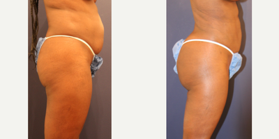 Brazilian Butt Lift before and after photo