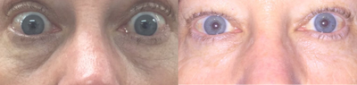 Dermal Fillers before and after photo