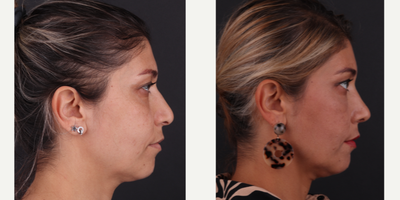 Facial Fat Transfer before and after photo