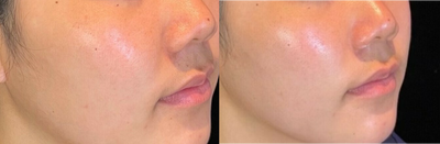 HydraFacial before and after photo