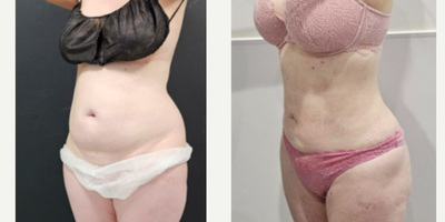 Renuvion before and after photo