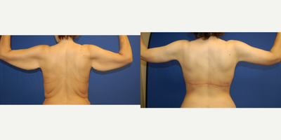 Body Lift before and after photo