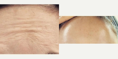 Botox before and after photo