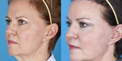 Brow Lift before and after photo