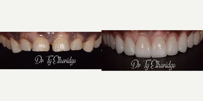 Dental Crown before and after photo