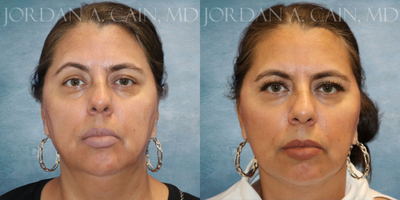 Facelift before and after photo