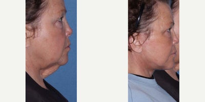 Facelift before and after photo