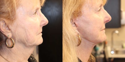Facelift before and after photo