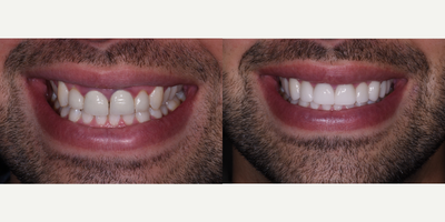 Gum Lift before and after photo