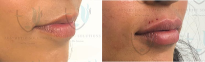 Juvederm before and after photo