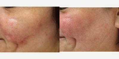 Laser Scar Removal before and after photo