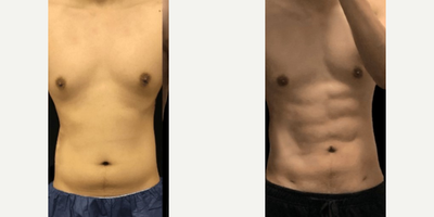 Liposuction before and after photo