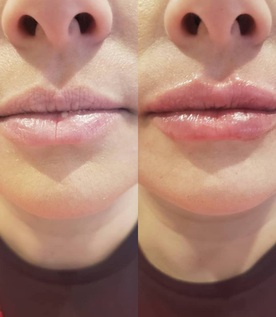 Revanesse before and after photo
