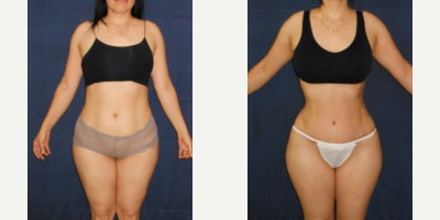Brazilian Butt Lift before and after photo