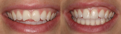 Dental Bonding before and after photo
