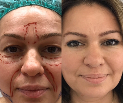 Facial Fat Transfer before and after photo