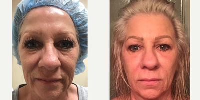 Fractional Laser before and after photo