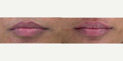 Lip Fillers before and after photo