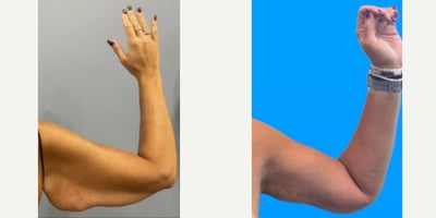 Arm Lift before and after photo