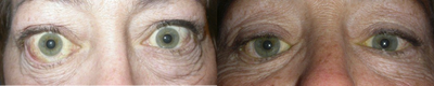 Facial Reconstructive Surgery before and after photo