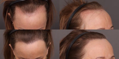Hair Transplant before and after photo