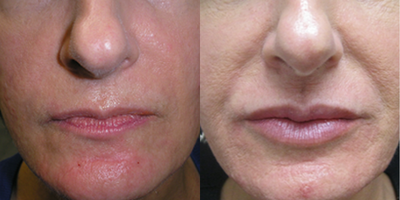 Juvederm before and after photo