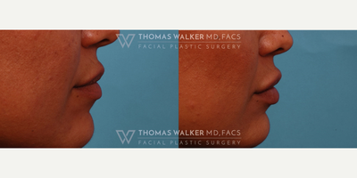 Juvederm before and after photo