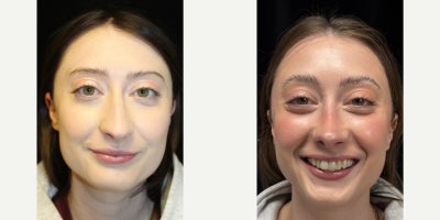 Rhinoplasty before and after photo