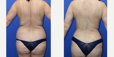 Tummy Tuck before and after photo