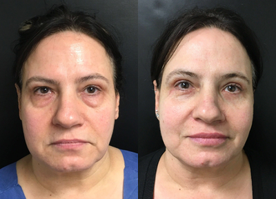 Eyelid Surgery before and after photo