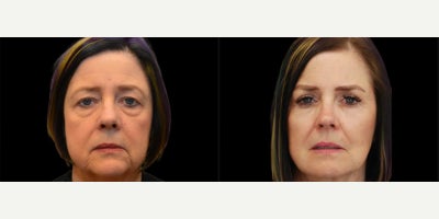 Facelift before and after photo