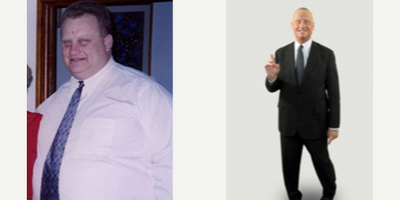Gastric Bypass before and after photo