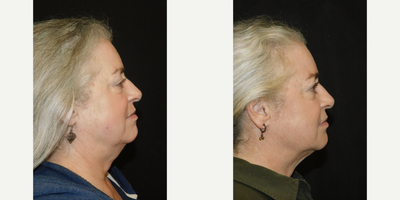 Juvederm before and after photo