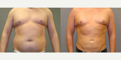 Liposuction before and after photo