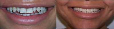 Lumineers before and after photo