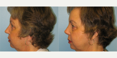 Rhinoplasty before and after photo