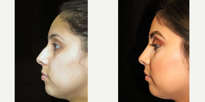 Rhinoplasty before and after photo